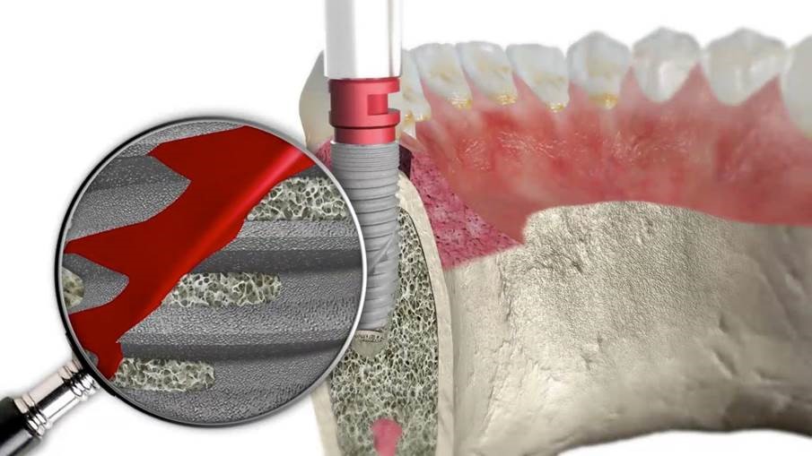 BEGO Semados® RS/RSX-Zahnimplantate aus Rein-Titan Grad 4 mit bionischen Mikrorillen bilden eine hervorragende Grundlage für ein langfristiges Hart –und Weichgewebsergebnis.