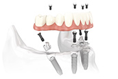 Unterkieferprothese mit Multi-unit Abutments positionieren