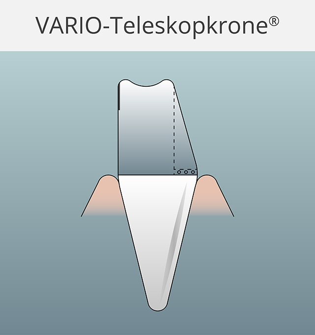 Die VARIO-Teleskopkrone®: Das Design der Primärkrone erlaubt die optimale Friktion der Sekundärkrone.