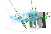 Prothetikorientierte 3D-Implantatplanung