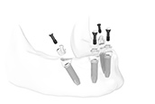 Gerade und rotationsgesicherte Multi-unit Abutments platzieren