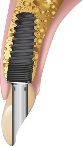 Implantat-System „Deep-Conical“ mit bewährter Southern Implants Oberfläche: Ein Co-Axis-Implantat mit einer Frontzahnkronenneigung von 12 °, die den Einsatz eines geraden Abutments erlaubt und so eine perfekte Frontzahnästhetik gewährleistet.