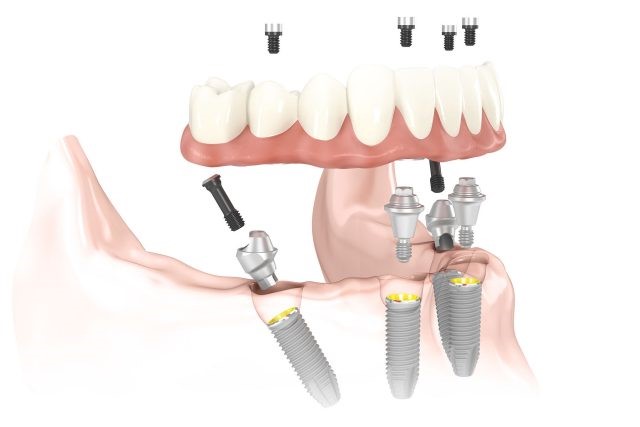 Das All-on-4® Behandlungskonzept - „Feste Zähne an einem Tag“